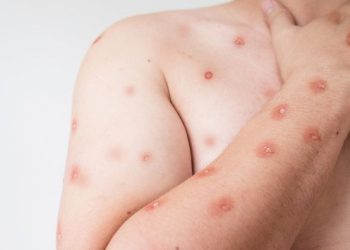 Mpox: diretor do Ministério da Saúde tira dúvidas sobre sintomas, transmissão e cuidados para evitar a doença