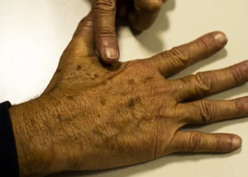 Câncer de pele: com a chegada do verão, prevenção é fundamental para evitar a doença