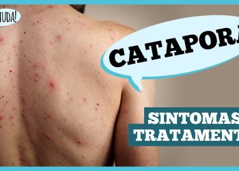 Catapora: sintomas, complicações e prevenção