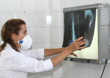 Tuberculose: Amazonas lidera incidência no Brasil, seguido por Roraima e Rio de Janeiro