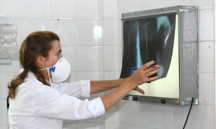 Tuberculose: Amazonas lidera incidência no Brasil, seguido por Roraima e Rio de Janeiro