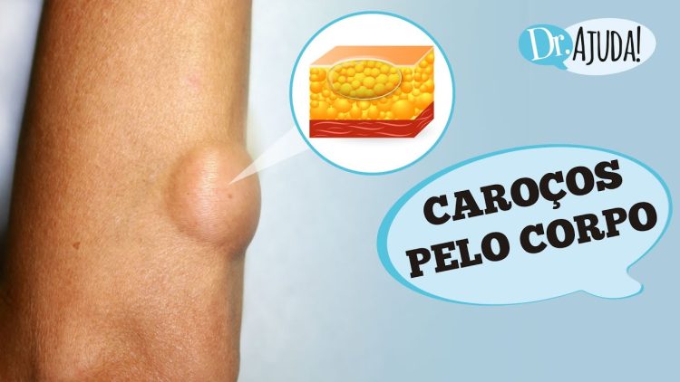 Caroços pelo corpo e lipoma: O que são? O que reparar?