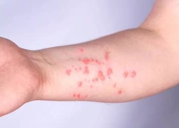 Mpox: Brasil registra 140 casos em 2026